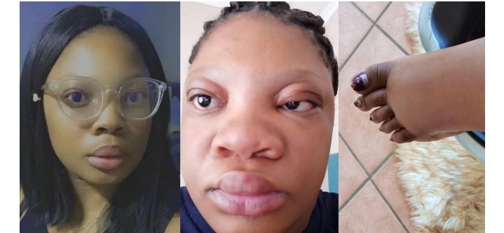 “Is she allergic to pregnancy?” – Lady’s pregnancy transformation sparks concern Her face doubled in size during